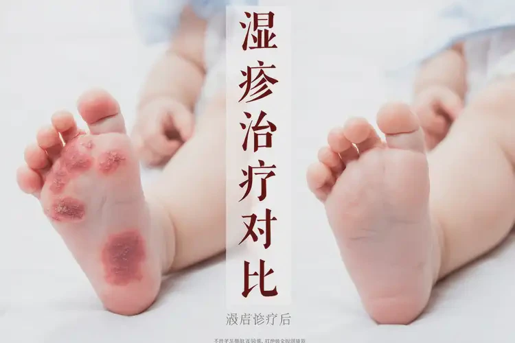 寶寶腳上容易起濕疹可以治好嗎(圖4)
