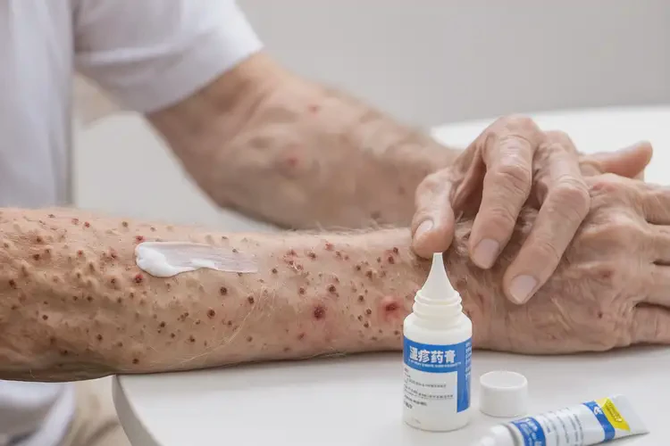 老年人手臂上经常起湿疹可不可以根治(图4)