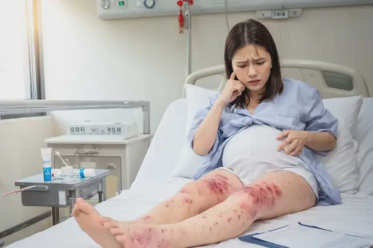 產(chǎn)婦大腿上經(jīng)常起濕疹可以治好嗎(圖4)
