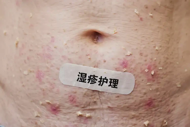 高齡老人肚子上容易起濕疹可以徹底自愈嗎(圖4)