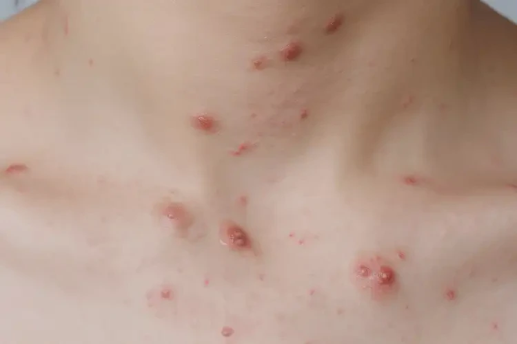 青少年脖子出濕疹可以治好嗎(圖4)