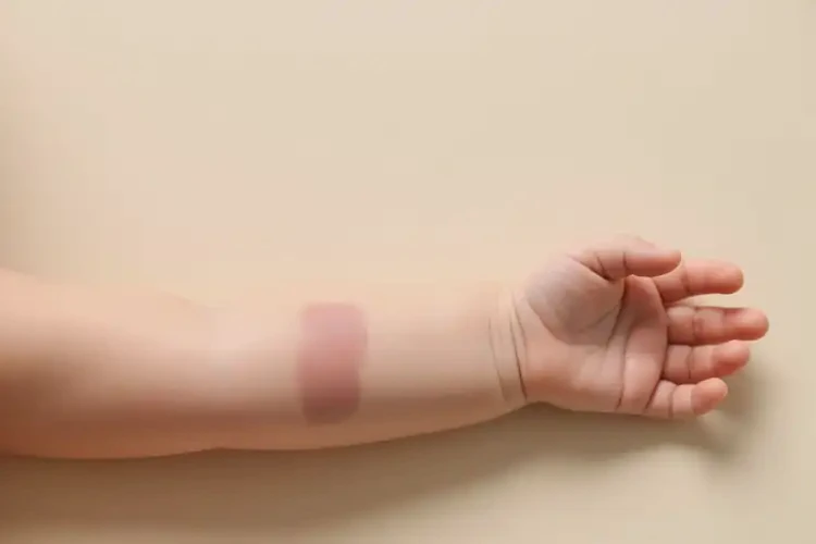 寶寶手臂長濕疹可以治好嗎(圖2)