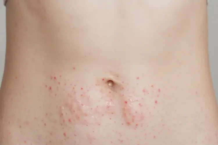 女生肚子經(jīng)常長(zhǎng)濕疹可以治好嗎(圖4)