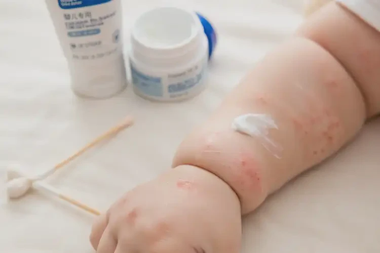 寶寶手臂上有濕疹可以治好嗎(圖3)