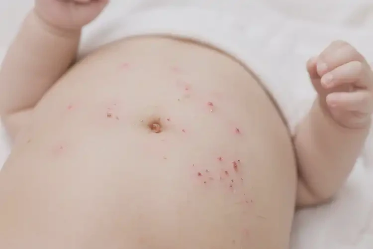 孩子肚子出現(xiàn)濕疹可不可以徹底自愈(圖4)