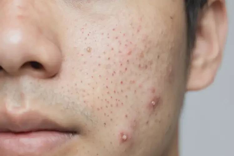 男生臉上長濕疹可以治好嗎(圖4)