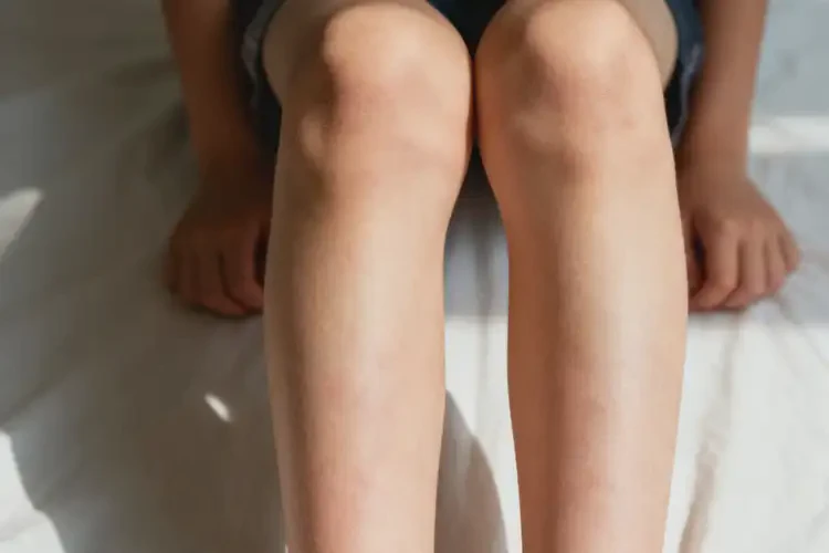 青少年小腿上出濕疹可以治好嗎(圖1)