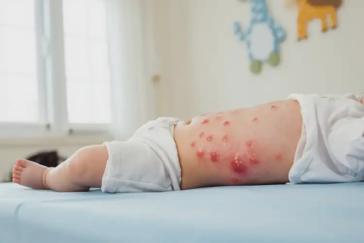 幼兒肚子上出現(xiàn)濕疹可不可以根治(圖2)