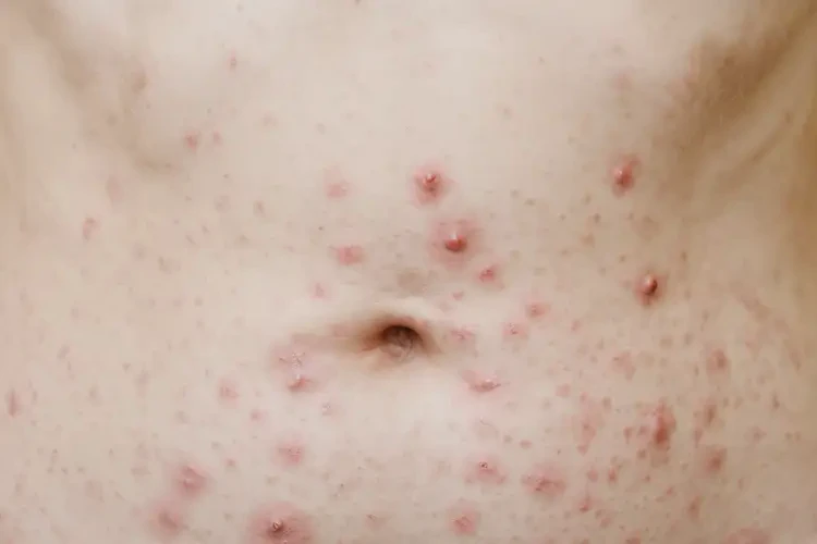 女性肚子容易長(zhǎng)濕疹可以治好嗎(圖4)