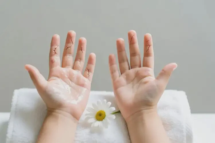 孩子手上偶爾起濕疹可以治好嗎(圖2)