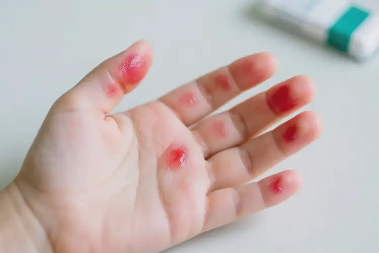 少兒手上容易長濕疹可以治好嗎(圖4)