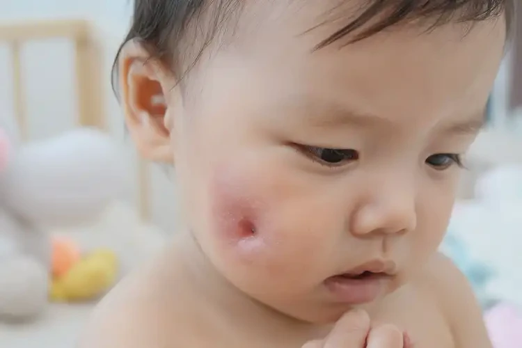 小兒屁股上偶爾起濕疹可不可以根治(圖3)