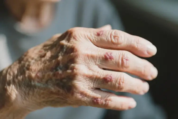 老年人身上经常长湿疹可不可以根治(图4)