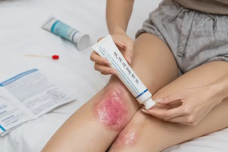 女性大腿偶爾起濕疹可以治好嗎(圖4)