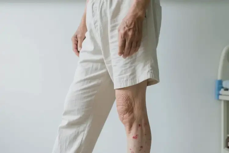 老人大腿上偶爾長(zhǎng)濕疹可以治好嗎(圖3)