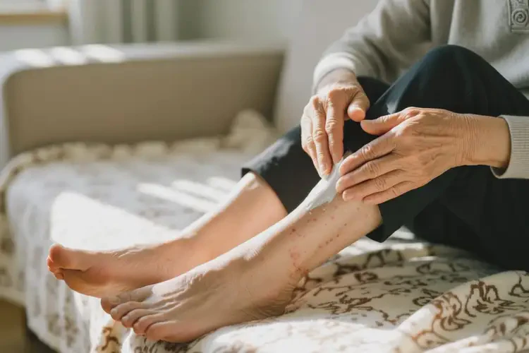 高齡老人腳上長濕疹可不可以根治(圖4)