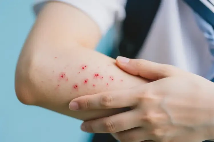 大學(xué)生手臂偶爾起濕疹可以治好嗎(圖3)