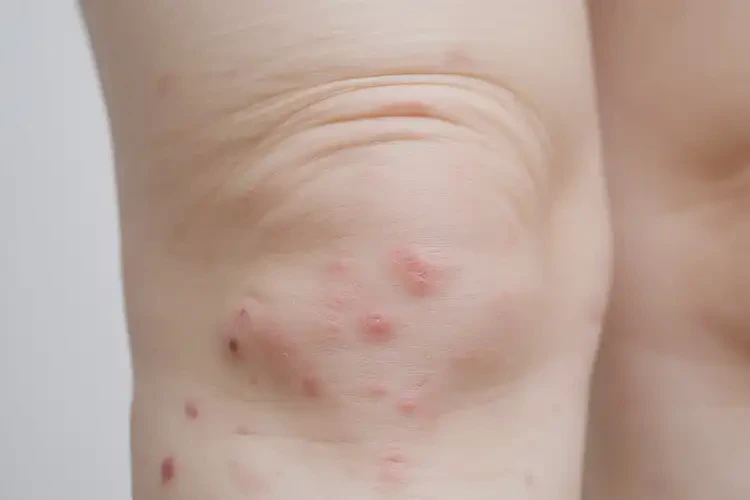 少兒大腿上容易起濕疹可以治好嗎(圖4)