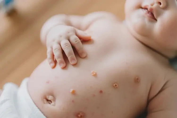 新生兒肚子偶爾起濕疹可以治好嗎(圖2)
