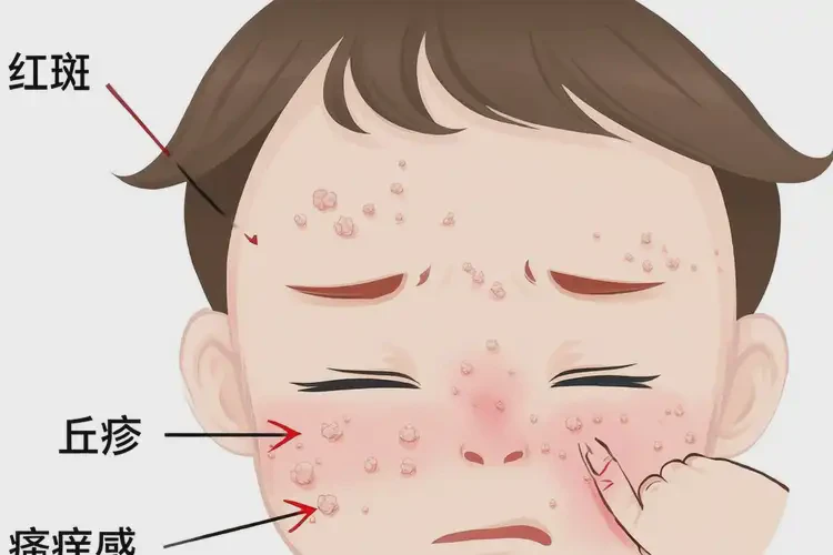 孩子面部經(jīng)常起濕疹可以徹底自愈嗎(圖4)