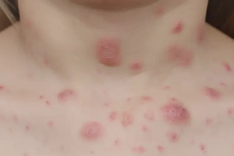 兒童脖子上容易長濕疹可以治好嗎(圖4)