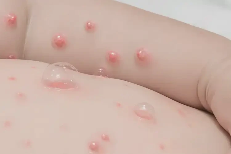 幼兒手臂經(jīng)常長(zhǎng)濕疹可以治好嗎(圖4)