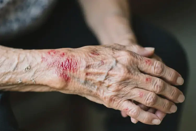 高龄老人手臂经常起湿疹可不可以根治(图1)