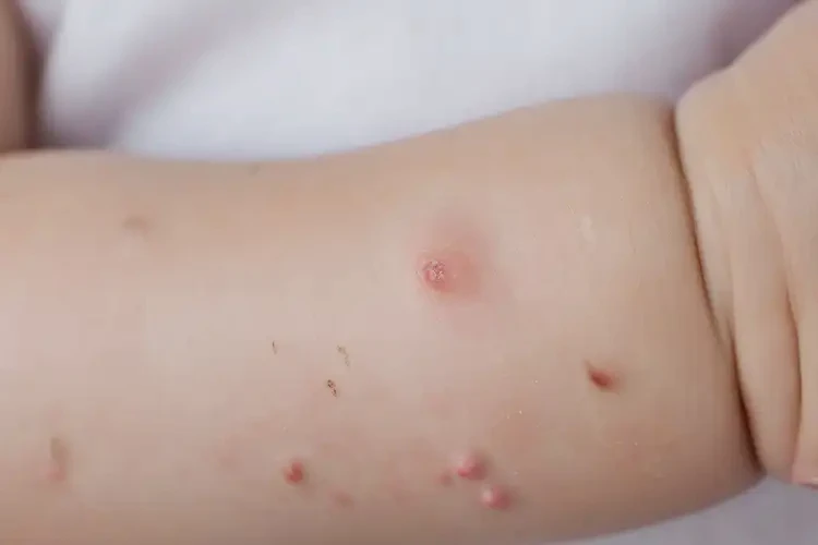 幼兒手臂容易長(zhǎng)濕疹可以治好嗎(圖4)