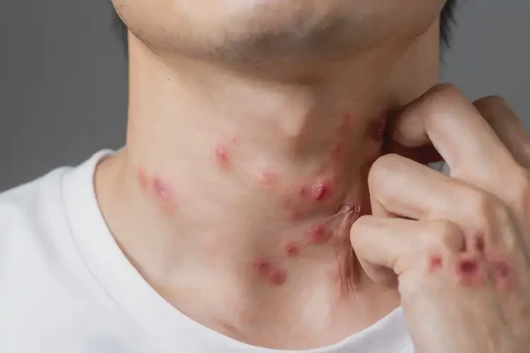 男生脖子有濕疹可以治好嗎(圖4)