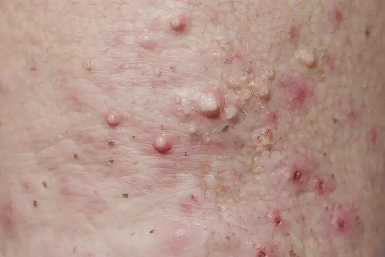 男生肛周出現(xiàn)濕疹可不可以根治(圖4)