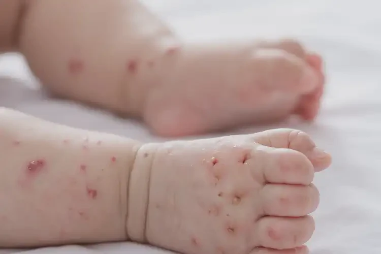 嬰幼兒四肢容易長(zhǎng)濕疹可以治好嗎(圖4)