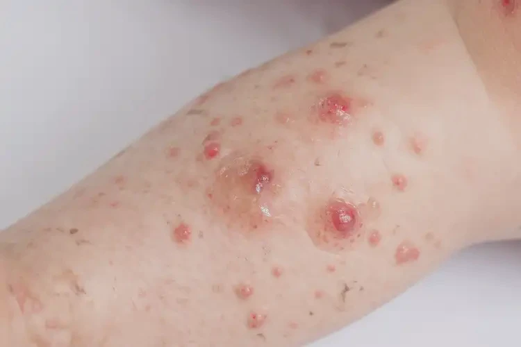 兒童小腿經(jīng)常長(zhǎng)濕疹可以治好嗎(圖4)