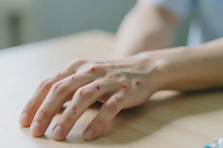 男生手上偶爾長濕疹可不可以根治(圖4)