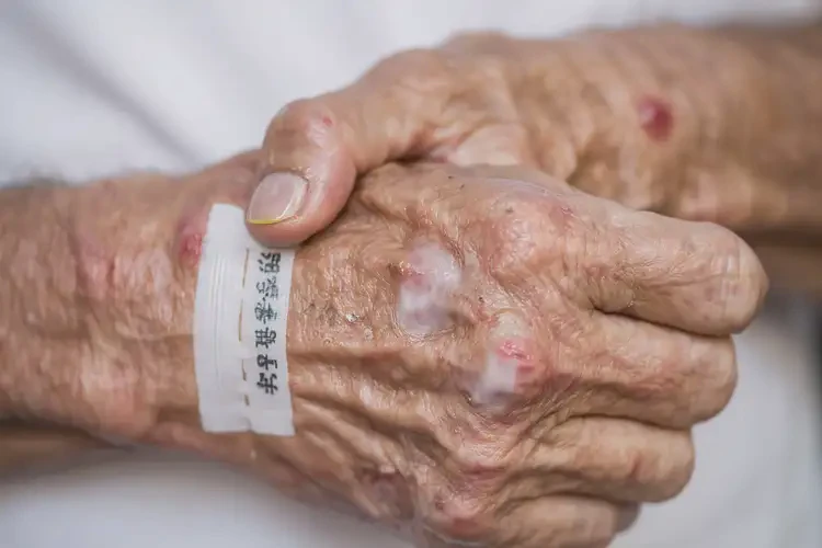 老年人手上有濕疹可以治好嗎(圖4)