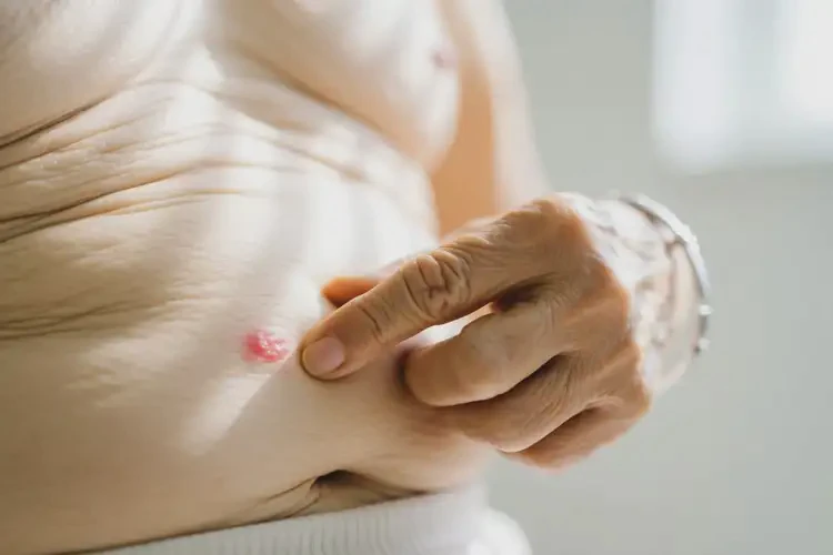 老年人肚子偶爾長濕疹可以治好嗎(圖3)