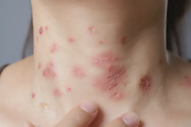 產婦脖子容易起濕疹可以治好嗎(圖4)
