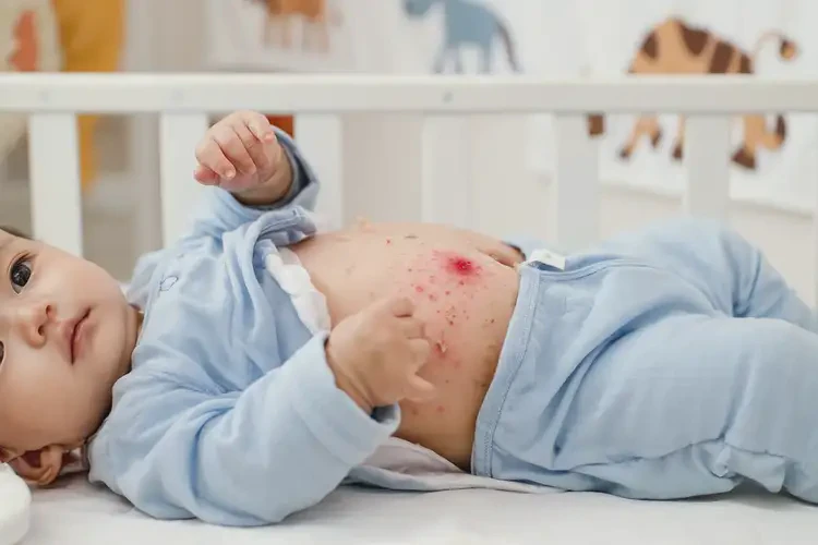 寶寶肚子偶爾起濕疹能夠徹底治愈嗎(圖3)