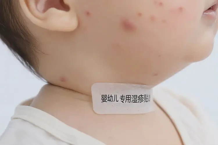 小孩脖子偶爾起濕疹能徹底自愈嗎(圖4)