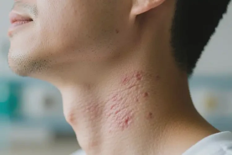 男人脖子有濕疹可不可以根治(圖4)