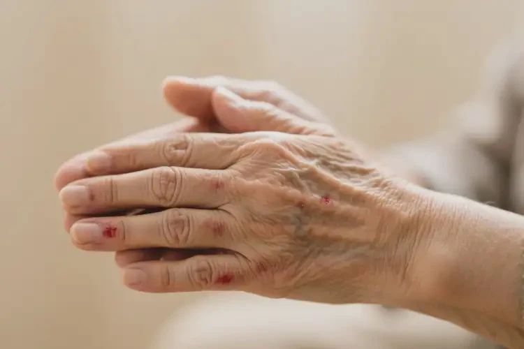 老年人手上偶爾起濕疹可以治好嗎(圖4)