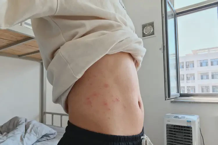 大學(xué)生肚子有濕疹能徹底自愈嗎(圖3)