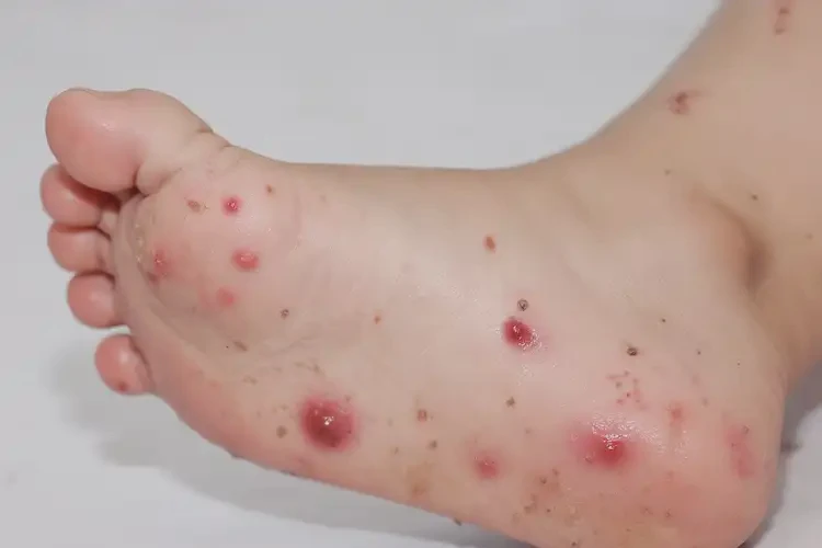 少兒腳上起濕疹可以治好嗎(圖4)