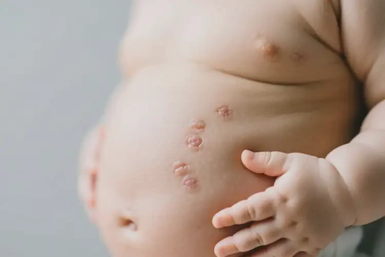 小兒肚子有濕疹可以治好嗎(圖1)