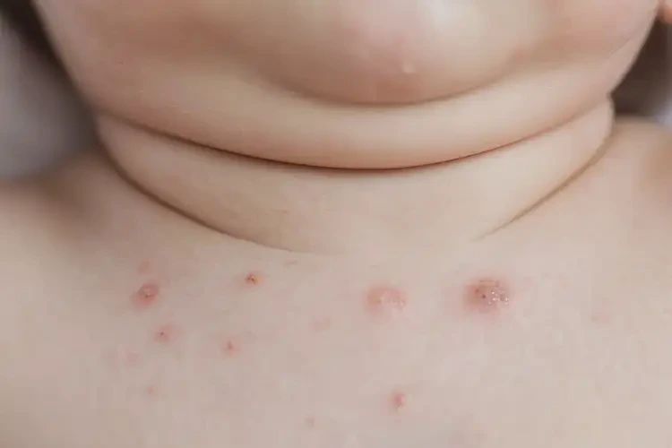 嬰幼兒脖子上出濕疹能徹底自愈嗎(圖4)