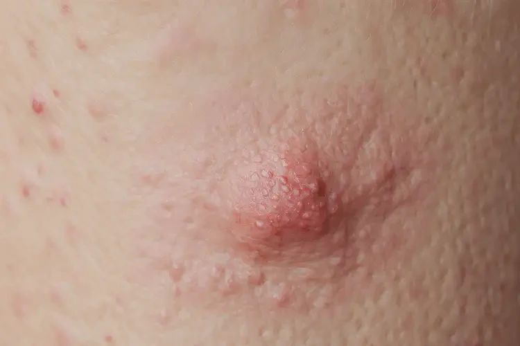 小孩手臂出濕疹可以治好嗎(圖4)