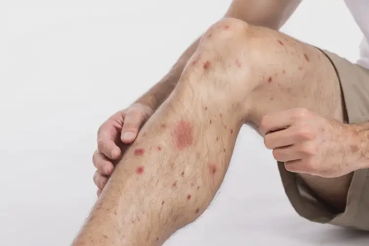 青年人大腿上偶爾起濕疹可以治好嗎(圖4)