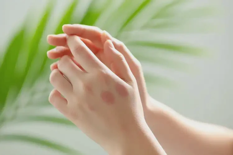 女生手上長(zhǎng)濕疹可以治好嗎(圖2)