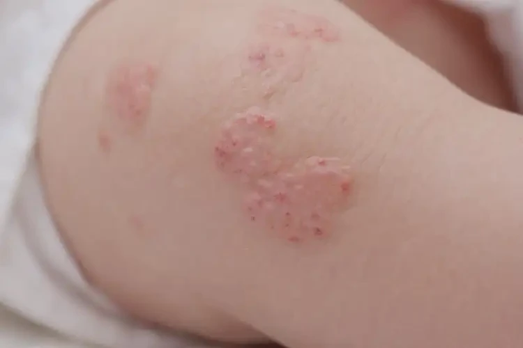 新生兒大腿上偶爾起濕疹可以治好嗎(圖4)