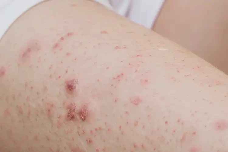 產(chǎn)婦屁股上起濕疹可以徹底自愈嗎(圖4)