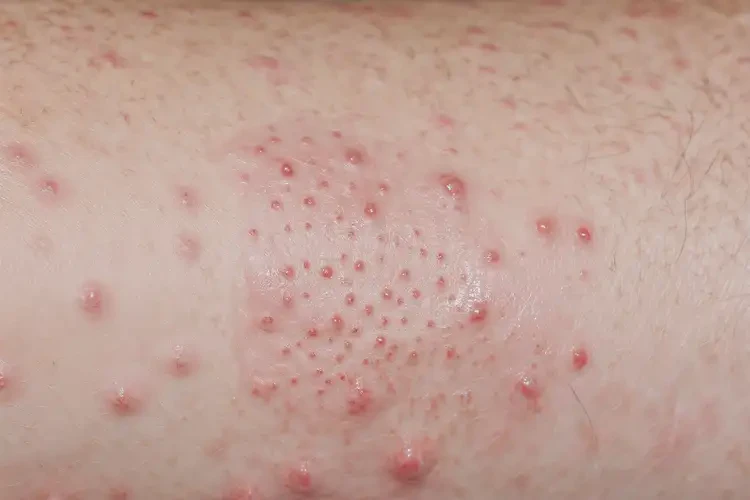 男性手臂上出濕疹可以治好嗎(圖4)